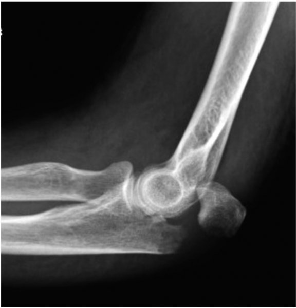Olecranon Fracture
